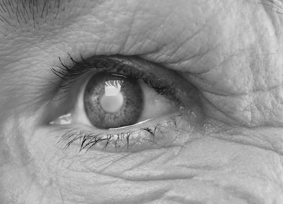 Chirurgie de la cataracte OPH78 Centre Ophtalmologique de l’Ouest Parisien