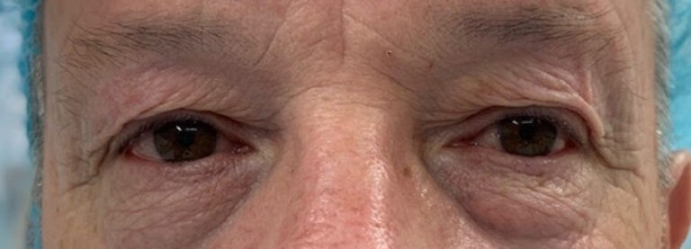 Le dermatochalasis : symptômes & traitements - Yvelines ...