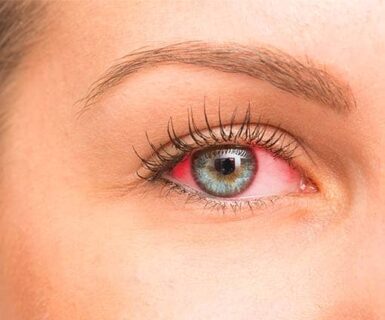 Oeil rouge : les symptômes à ne pas négliger d’une conjonctivite | OPH 78 | Le Port Marly